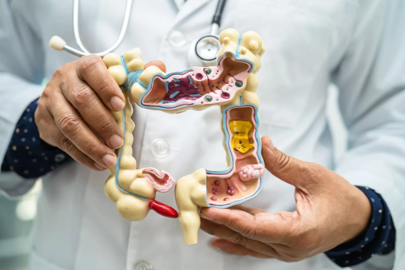 Detection of Colon Cancer