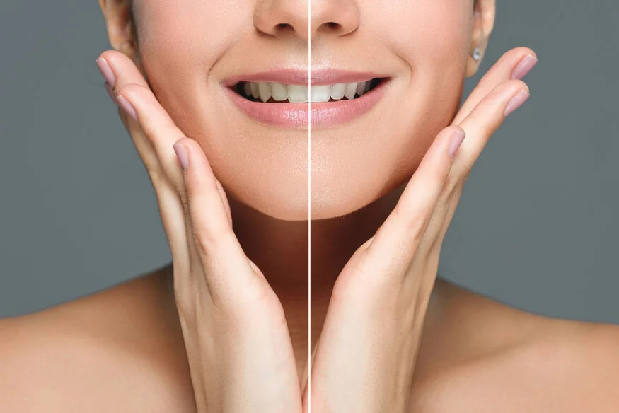 Exploring the Benefits of Professional Teeth Whitening Professional Teeth Whitening