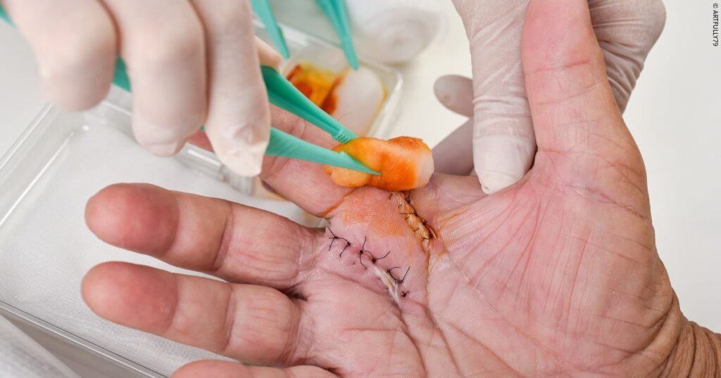 Early Intervention in Wound Care