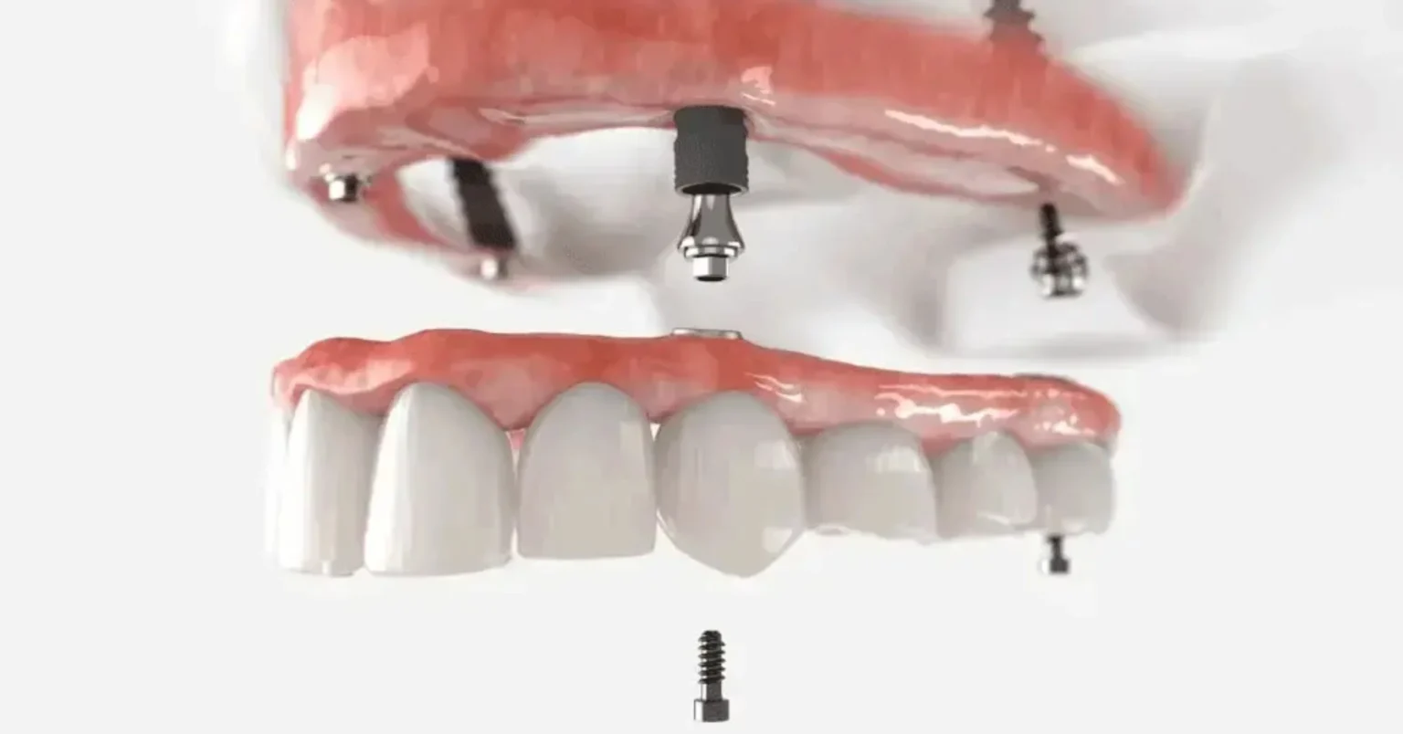 All-On-X Dental Implants