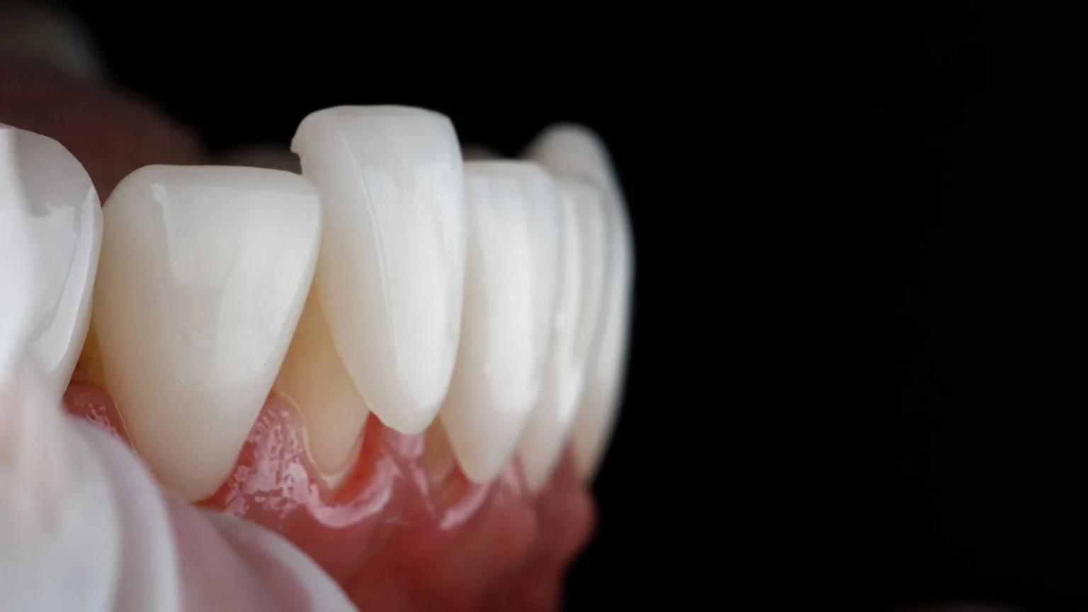 Understanding the Different Types of Veneers Available Different Types of Veneers