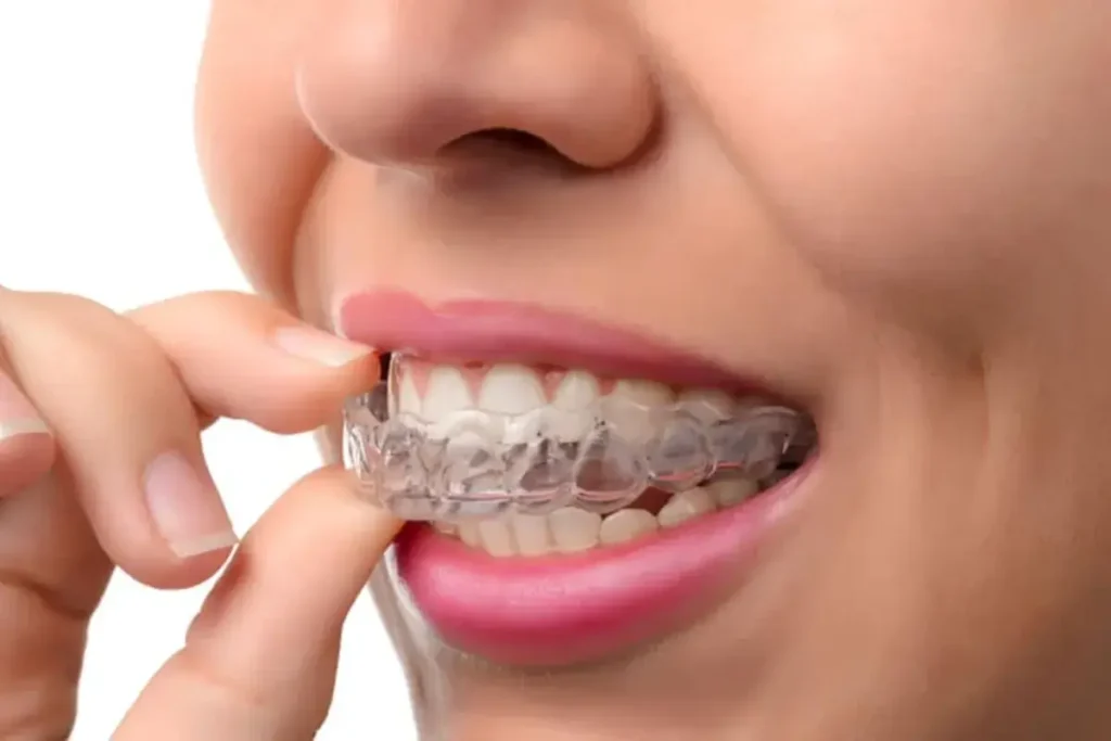 4 Reasons To Seek Invisalign Treatment Invisalign Treatment